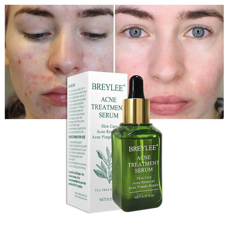 BREYLEE Acne Treatment Serum Face Facial Anti Acne Scar Removal Cream Periwinkle Abderus