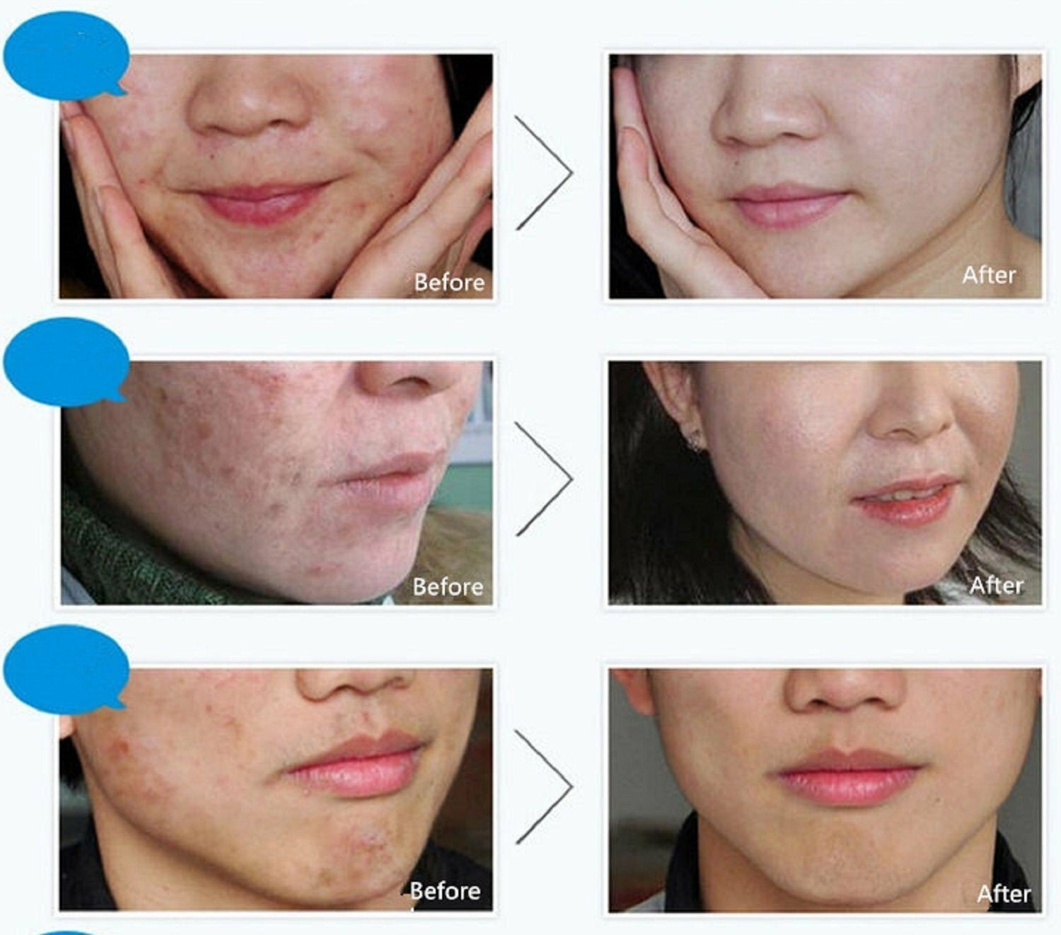 BIOAQUA Face Skin Care Acne Treatment Removal Cream Spots Scar Blemish Marks