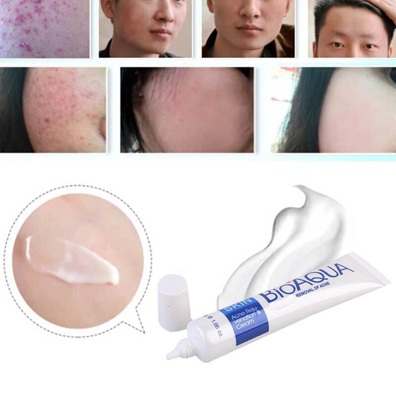 BIOAQUA Face Skin Care Acne Treatment Removal Cream Spots Scar Blemish Marks
