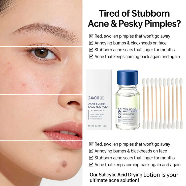 Salicylic Acid Drying Lotion Face Serum with Cotton Swab– Reduce Pimples & Breakouts Fade Acne Scars Minimize Pores Skin Renewal Khamik Shop Online