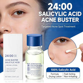Salicylic Acid Drying Lotion Face Serum with Cotton Swab– Reduce Pimples & Breakouts Fade Acne Scars Minimize Pores Skin Renewal Khamik Shop Online