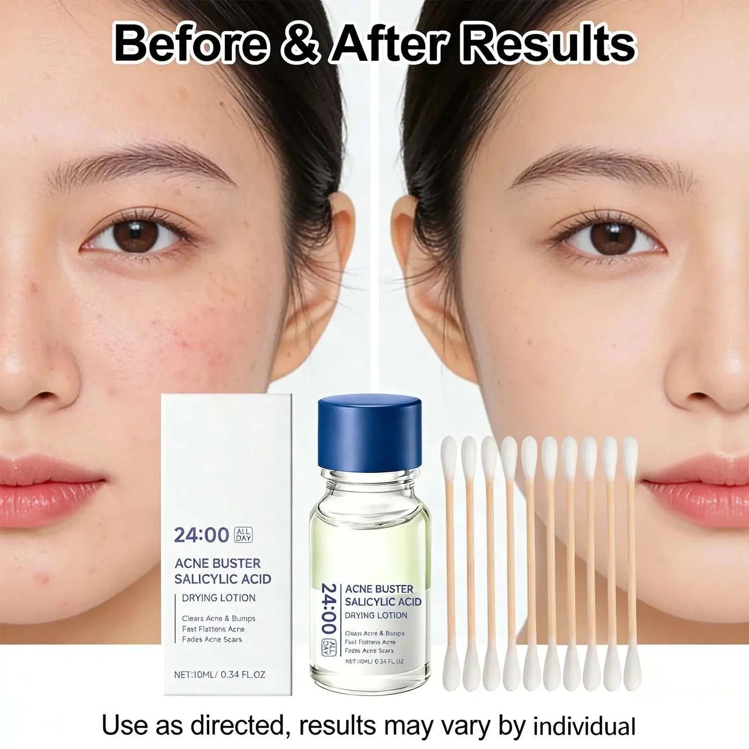 Salicylic Acid Drying Lotion Face Serum with Cotton Swab– Reduce Pimples & Breakouts Fade Acne Scars Minimize Pores Skin Renewal Khamik Shop Online